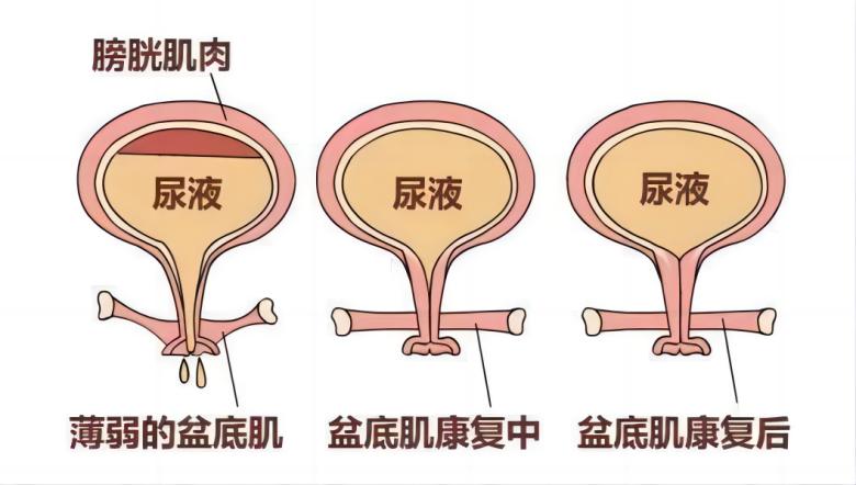 羽豐醫(yī)療丨如何有效運用振動提高盆底肌肉激活水平？